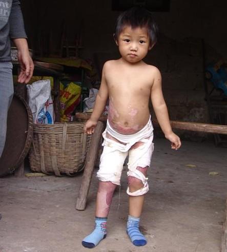 ���Ǹոմ������ͯҽԺ��Ժ��С���Σ����ϵı�����û�н⿪����Ϊû��Ǯ�����˺���ֻ�ܳ�Ժ�������˿ڸ�Ⱦʹ�ĺ������۽С������Ѿ�ס���ڽ���һ����ҽԺ