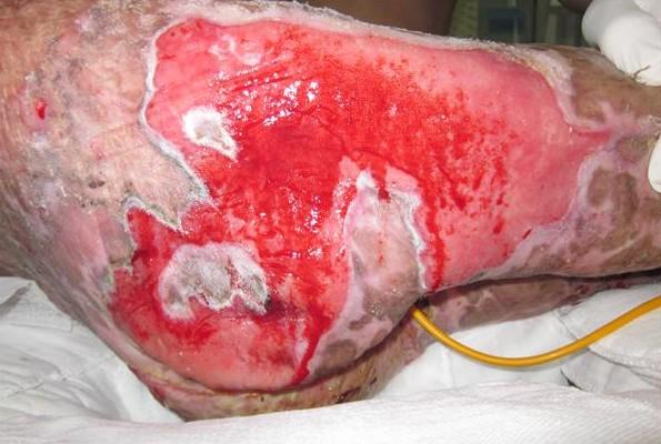 �����β���˫��֫�������ˣ���Ƥ�Ѿ���ʼ���䣬�����µ���ѿ����