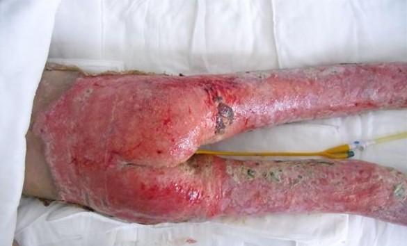 ��ҩ�����е����ษ���ڷ������ϣ�������õ��ǻ������Ÿ�Ⱦ�����ִ�����ŧ�Է����������ϣ��СŮ����ǿ�������¸ҺͲ�ħ������