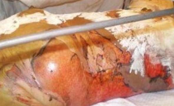 ����������Ƥ����ȫ��ֻ�к�����һ��Ƥ���ͽŵ�һ��Ƥ���Ǻõ�