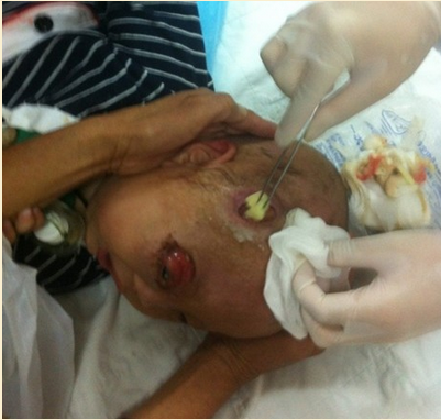 ͷ�ϵĶ���Ⱦ����ŧ���۾��Ѿ�û�����ˡ�������Ϊ����ŧ������Ҫ��ŧ�����󣬸��۾�������ϣ���ֹ�۾��ⷭ��Ⱦ������