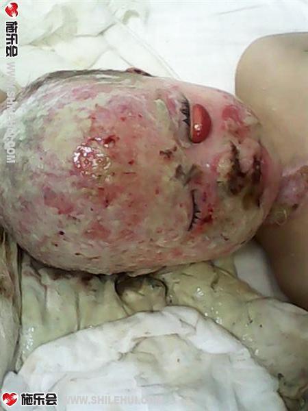 С���ձ��յ�ͷƤ��û���ˣ���֪���Ժ󻹻᲻�᳤��ͷ��������Ƥ�µ��Ǹ���Ѫ��ʮ�����˻�û����ȥ���۾�Ҳ�޷�������ֻ���ںڰ���ȹ�������������ʹ��