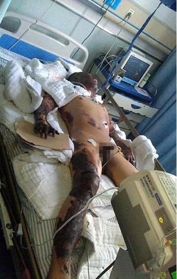 ���������65%���������3�ȣ�ÿ�춼������֢�໤���жȹ�