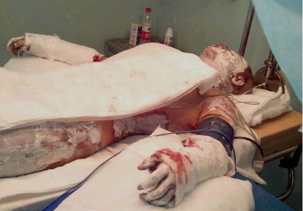 �����ϵļ��㣬������Ϳ���˸�ҩ��Ϊ�˷�ֹ��Ⱦ��ÿ�춼��������ϴ��ҩ������ơ����Ӻܶ��£��������Ʒǳ����