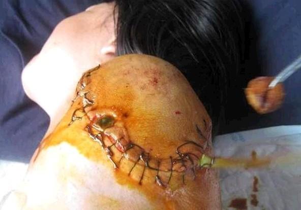 �����ĺ���ʧȥ��˫�ۣ��˿�һֱ��ŧ��ҽ���ڸ���������˿�