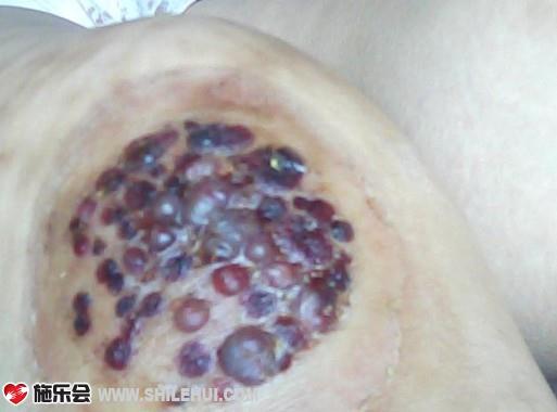 �����ҵ�ϥ�ǣ���ҽԺ���Ƶ�һ��ҩ��Ϳ�����͵Ĺؽ��ϼ���Сʱ���ؽ��Ͼͻ���ֺܶ��ݣ�ʵ���ǲҲ��̶�