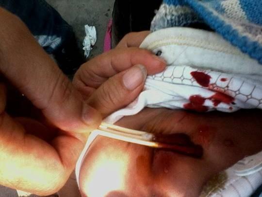 �ܰͽ��ŧ�����ѣ����¿�����˺ܶ�ŧѪ