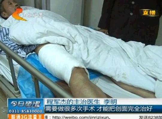 Ϊ��ʡҩ�ѣ�56����ϸ���ֲƤ��������������˥�������ڲ�����