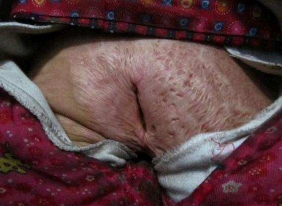 ����ĸ��ž�����������ţ������Ѿ��������󣬴�����ǰ���˺ܶ࣬ҽ�������ȱ������ơ�