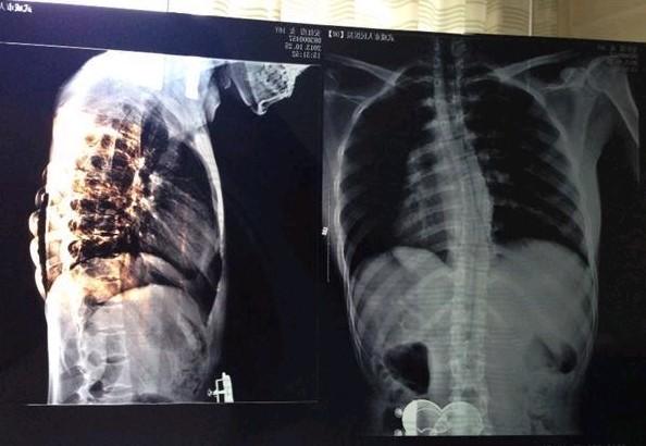 ����ϼ��X��Ƭ���ɼ�������S�ͣ�ҽ��˵�������ʱ����������ܿ��ܻ�̱��������������Σ��  