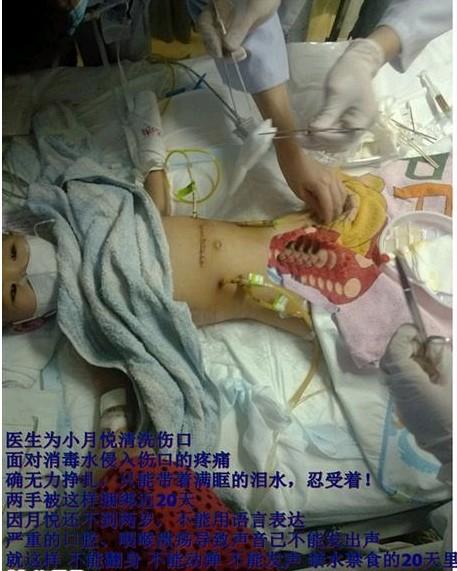 ҽ��ΪС������ϴ�˿ڣ�����ˮ�����˿ڵ���ʹ��ȷ����������˫�ֱ������20��