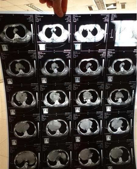 ���˿��ĵ�CTƬ���ķ����ŵ�Ƭ��