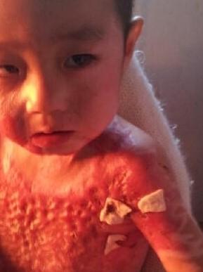 ����ֲƤȡ��ͷ�ϵ�Ƥ�������ӵ�ͷ��Ƥ��Ҳ�߲��ų��ֲ�ͬ��ɫ��