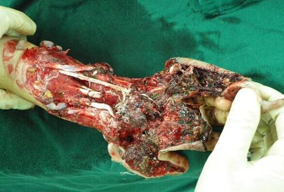 ���ǳ��µ���Ѫ��ģ�����֣�����ȫ�ǲ�м������޴������ˣ��粻�Ǵ��ҽ����տ��ҽ�¸�������ˡ�