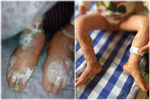 ���㽭ʡ����ҽԺƤ����סԺ��飬ȫ�������������ɫ����޷�վ����ȫ����ʹ����ʱ��С��ƴ��ץ���˿ڣ��۾��ﲼ����ɫѪ˿��ʹ��޽��ѹ���