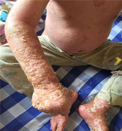 ������60������ң���������̫С���ܶ�ҽԺ���ҽ��գ���������Ƥ������վ��ת����Ƥ��������Ժ