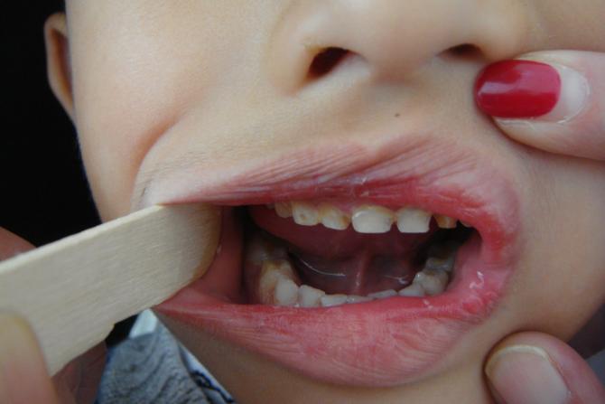 �������С�к����Ѿ�������ȣ�ݣ��������� �ڳ����񹤵�ũ����Ů��ƶ��ũ���ͯ����ʳ������ϰ�߶���Ϊ�ò����õĽ���Ӱ�죬���������С�������������ٷ�չ��ȥ��������Ӱ���ʳ���Ӷ�Ӫ���ϰ���