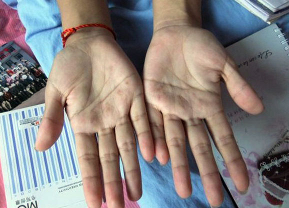 生病一年文娟曾经尝试过“扎手”刺激造血,手上留下四十个疤痕