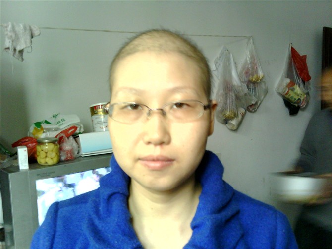 范媛化疗过程中造成头发全部脱落