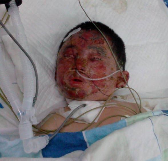 烧伤时在重症监护室,气管切开,呼吸机通气。