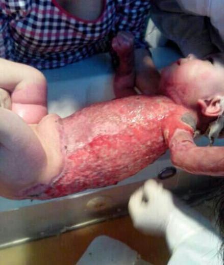 皓皓上半身全部烧伤很容易感染,但是小皓皓很坚强,一点都不哭