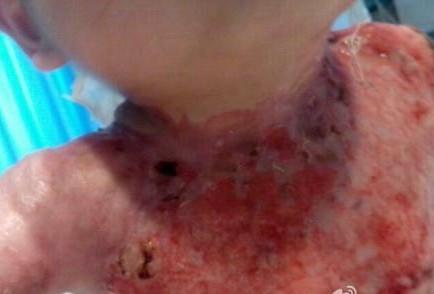 皓皓换药时照片