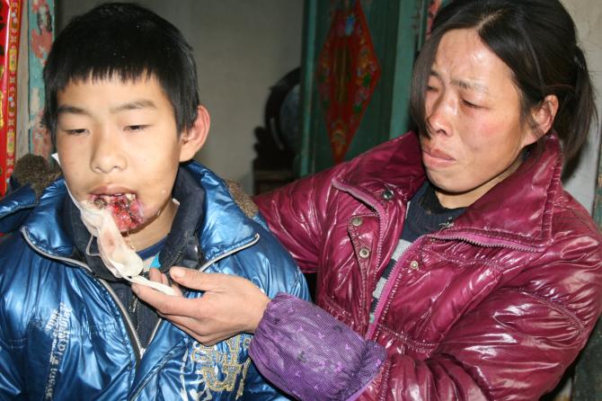 孩子下颚溃烂,母亲极度痛心