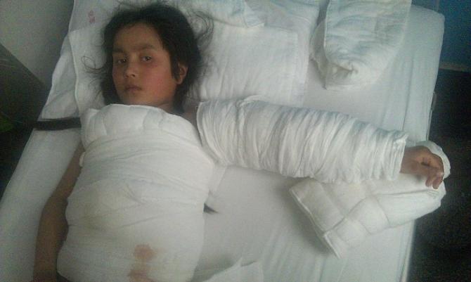 妹妹阿依苏丽坦的烫伤部位