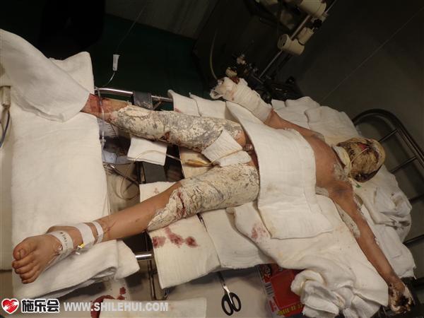 烧伤严重的房铭宣现在还处于昏迷状态,没有脱离生命危险!