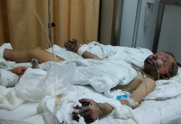 烧伤后紧急送入医院治疗