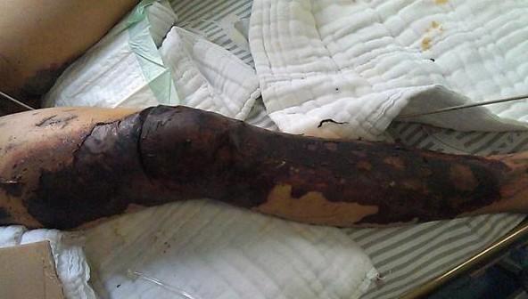 孩子被烧伤的腿部,皮肤都被烧焦了