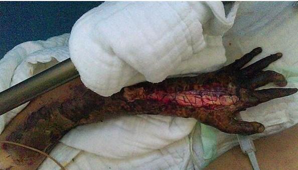 孩子的手臂开始溃烂,急需处理