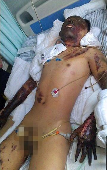 韩滨现在仍在重庆西南医院重症监护室,现因肾衰竭每天在做透析。