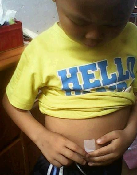 每天长达14个小时的排铁针痛,懂事的赵飞小小年纪要自己拔针。