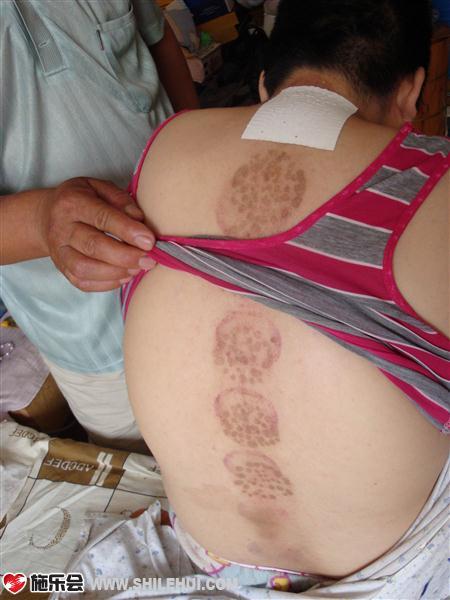 这是我的后背,用过火针和梅花针,还有出泡拔罐,整个脊柱都是疤痕