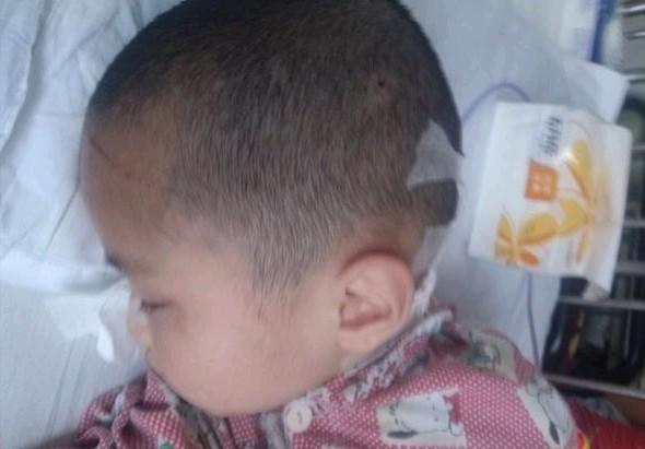 术后的索问头皮上刀痕累累,看着让人揪心