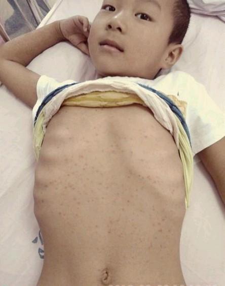 第一疗程之后引起的败血症和紫癜