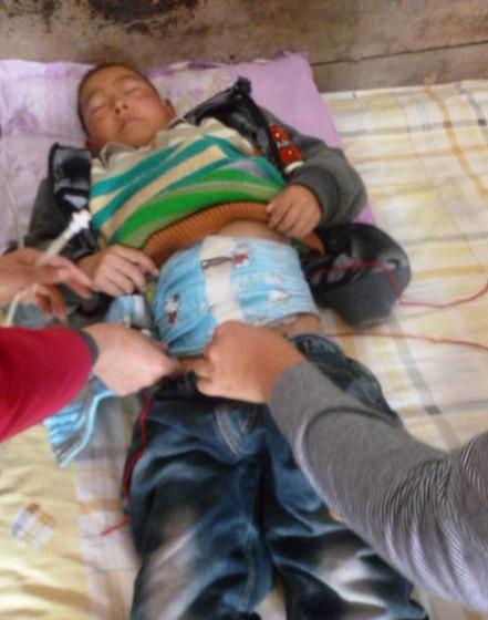 因为治疗没有钱,许俊杰在家里做引流把尿排来。