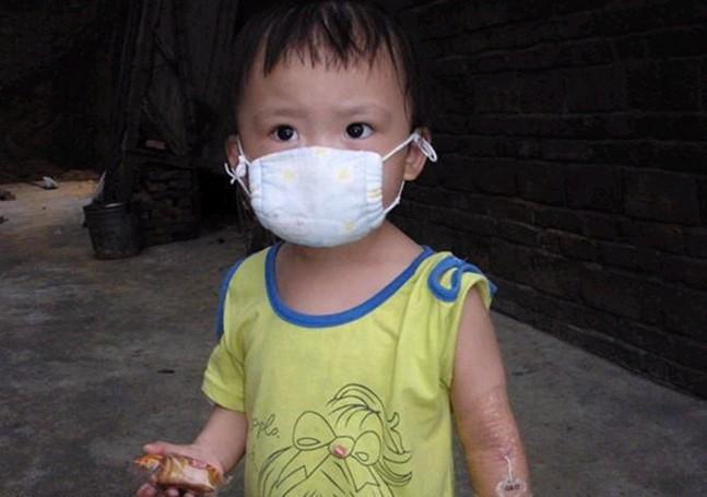 第5次化疗结束在家里恢复一段时间,为了防止感染,含含每天都需要戴着口罩,手臂上还留着滞留针