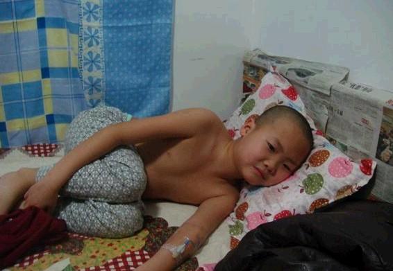 孩子住院两个月了,治疗了两个疗程,头发开始一缕一缕的往下掉,孩子问我:爸爸我这头发为什么往下掉。我比知道怎么回答。为了不让孩子害怕,给他把头发剪掉了。