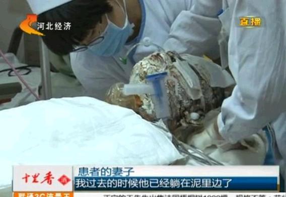 程军杰正在医院进行治疗,脸部涂上厚厚的药