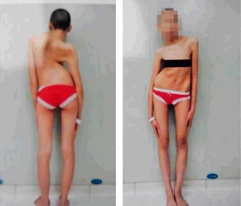 她的脊柱已经弯曲到了心脏,再不手术,就会很危险