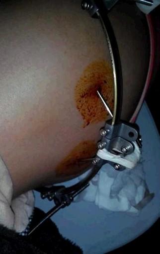 看着支架插进肉里,不是一般人能承受的痛苦