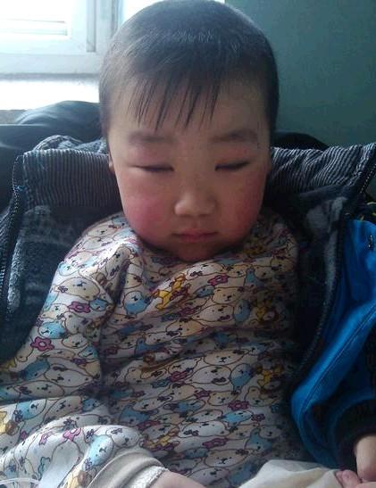 住院几天后肿消下来了,但孩子没有了往日的活泼