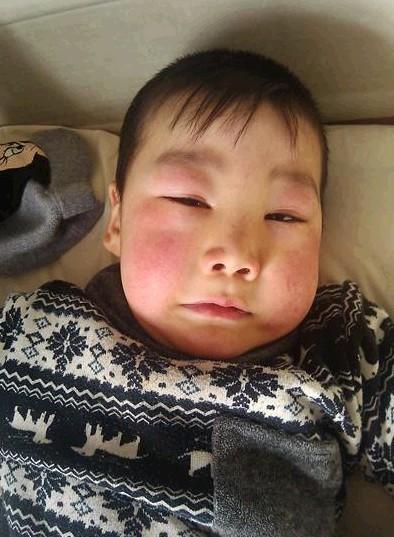 赵子文住院一周后肿消了下来的情况