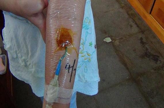 直通心脏的输液导管,因感染,流血不止!