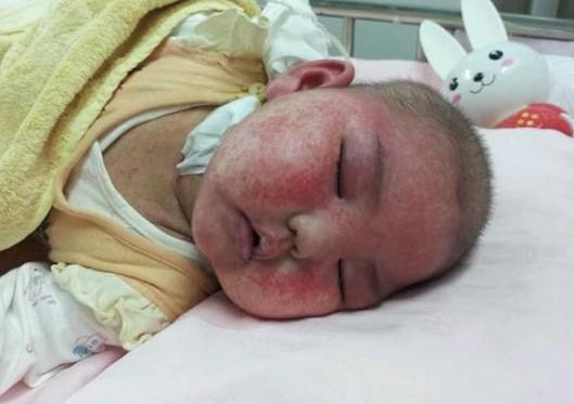 小婉瑜在医院治疗期间，由于疾病导致整张脸长满了红斑。