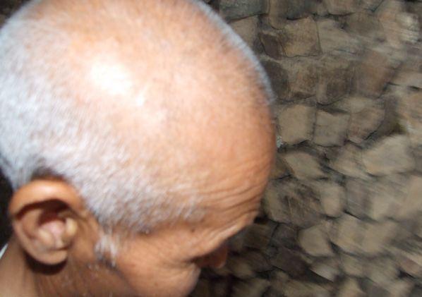 曹海根老人因为化疗头发已经部分掉光