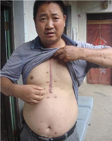 潘泽标的胸口留下了一天长长的伤疤