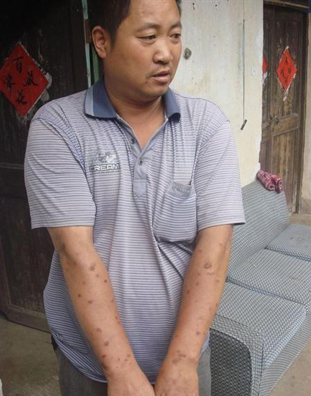 潘泽标手术之后身上长满了东西